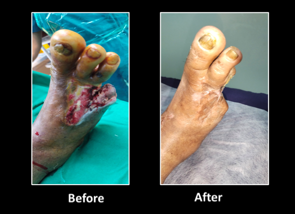 Diabetic-foot-2