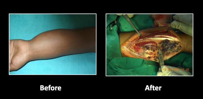 Vascular-malformations-2