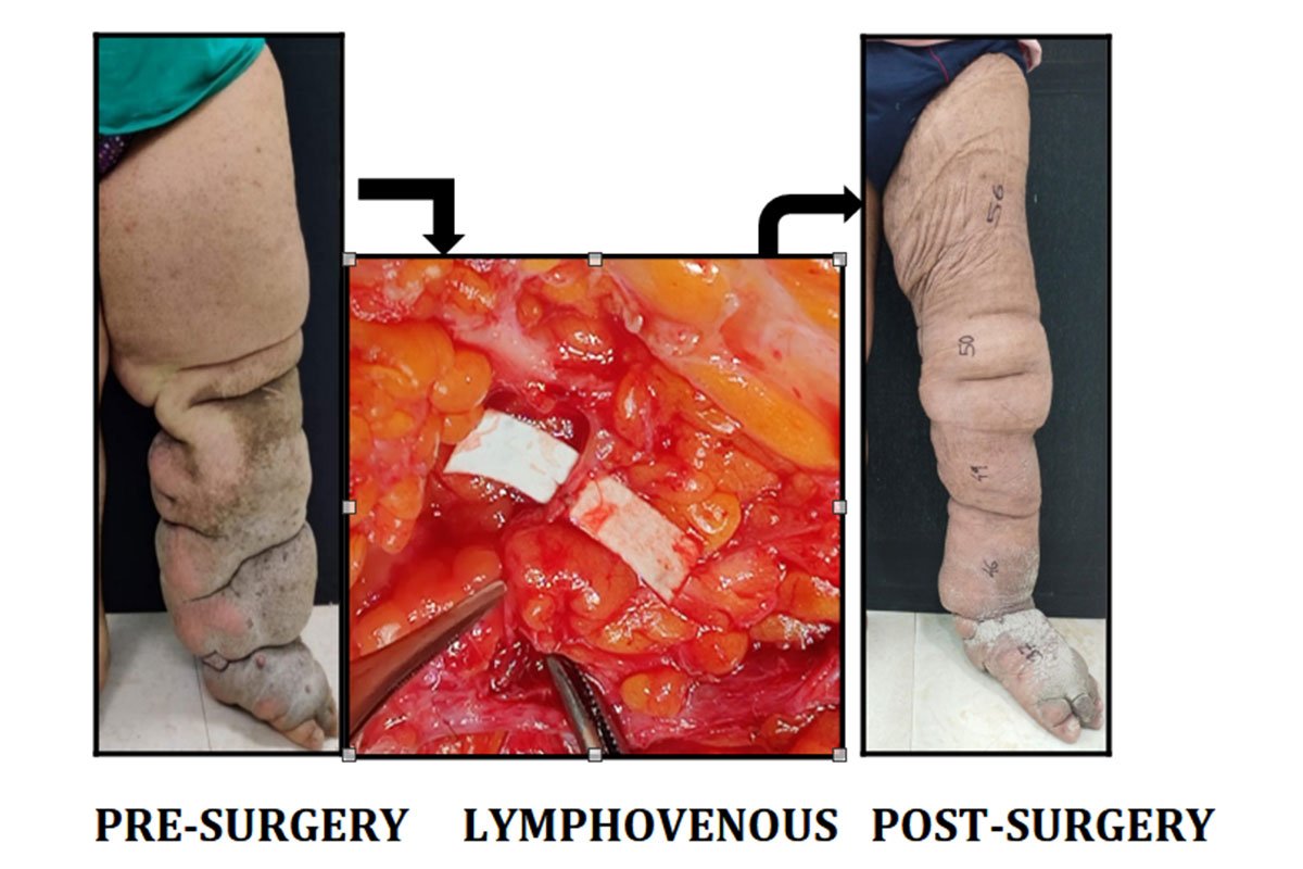 Lymphatic venous Bypass in the Treatment of Lower Limb Filariasis