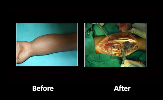 Vascular-malformations-2